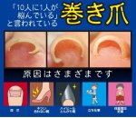 画像4: 巻き爪クッションシークレットテープ（お徳用60枚入） (4)