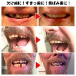 画像4: 本物・正規品インスタントスマイル「テンポラリーキットマルチセット」 (4)